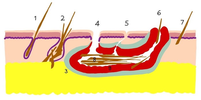 Steißbeinfisteln/Steißbeinaszessen | Proktologie am Stadtgarten | Ettlingen